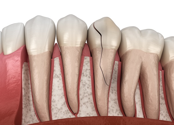 cracked tooth 3D illustration