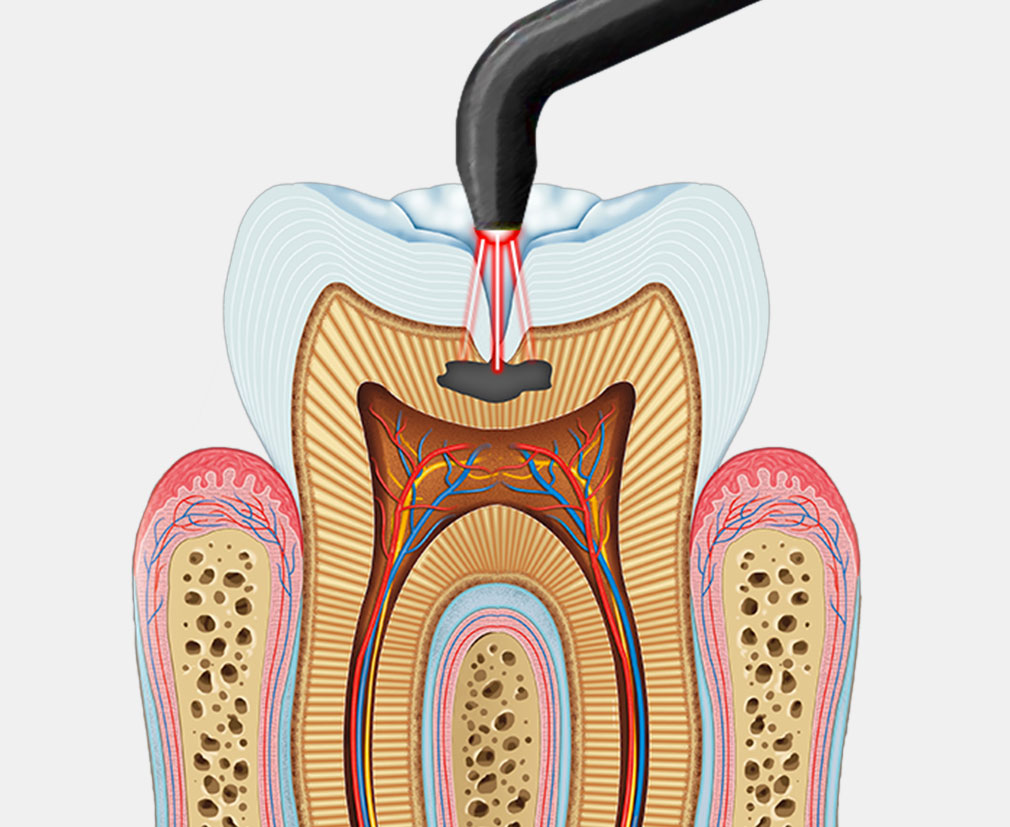 Laser Treatment of Dental Cavities