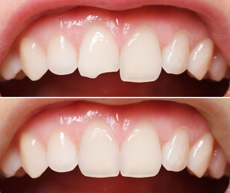 chipped tooth Vs. Normal shaped tooth