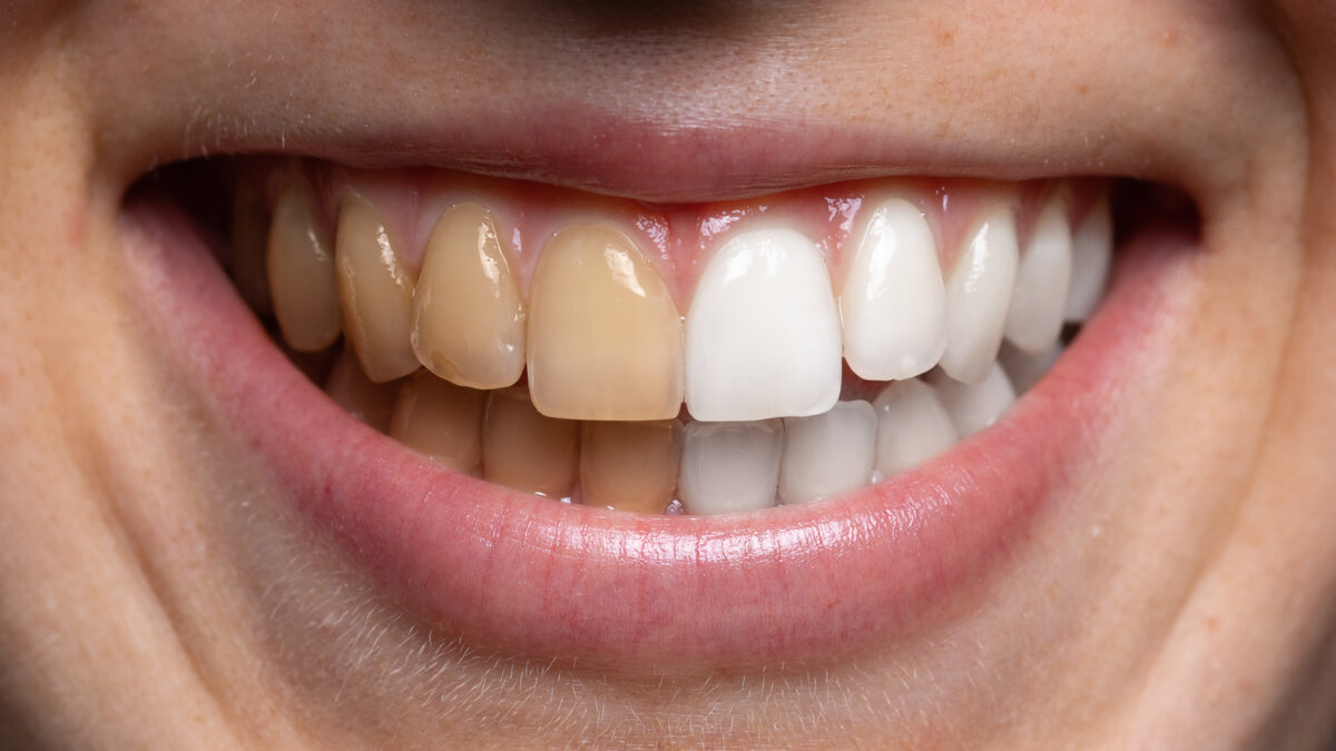 You Can Get Back Your Smile from the Teeth Stains
