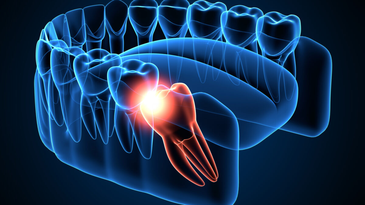 Things You Should Know About Wisdom Teeth Removal