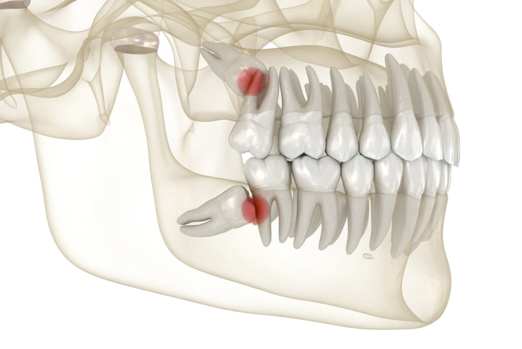 Things You Should Know About Wisdom Teeth Removal