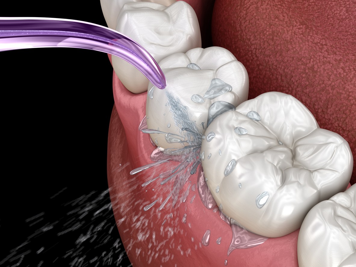 Dental Cavitation & Jawbone Infection