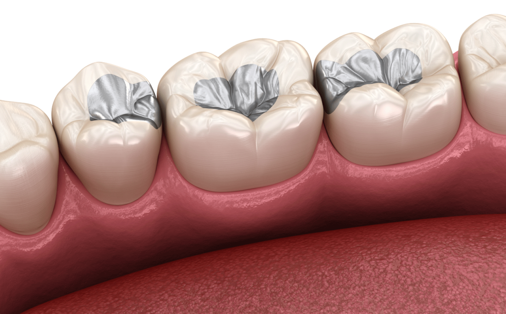 What Are the Symptoms of Mercury Poisoning from Amalgam Fillings?