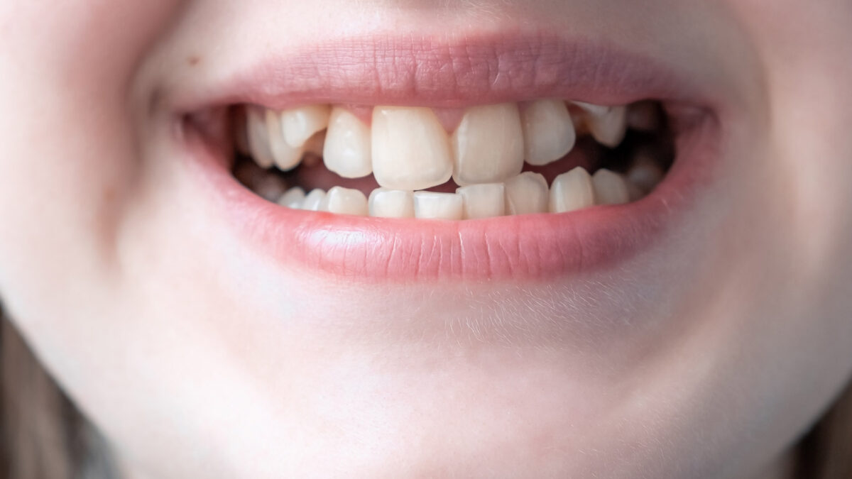 Crooked Teeth And How to Fix It