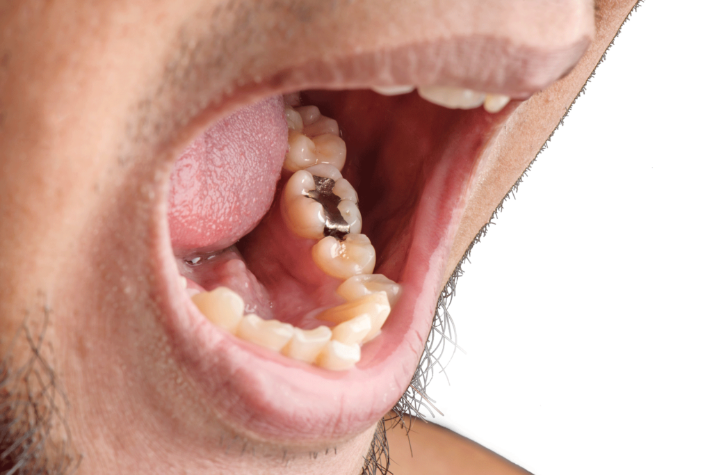 The Symptoms of Mercury Poisoning from Amalgam Fillings
