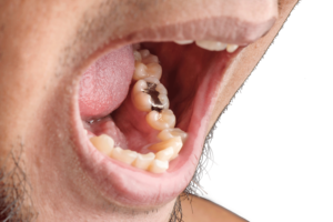 a man opening his mouth showing an amalgam filling