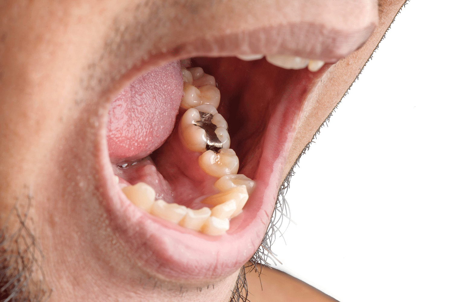 The Symptoms of Mercury Poisoning from Amalgam Fillings