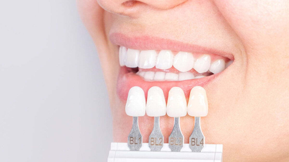 Everything You Should Know About Porcelain Crowns