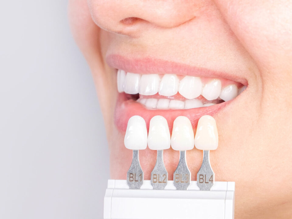 Everything You Should Know About Porcelain Crowns