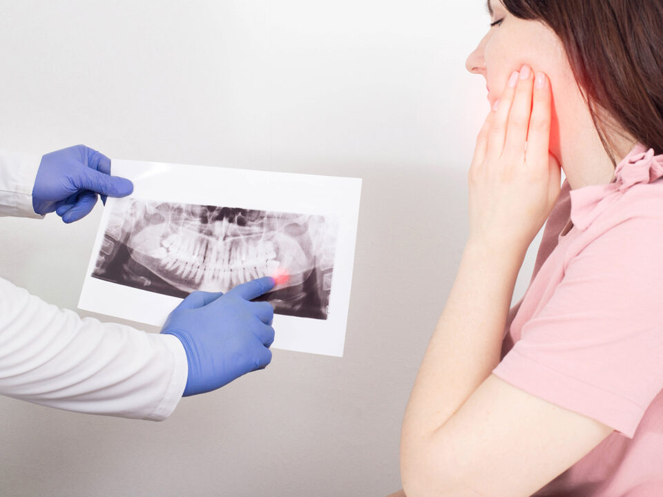 Benefits of Wisdom Teeth Extraction with L-PRF And Ozone Therapy