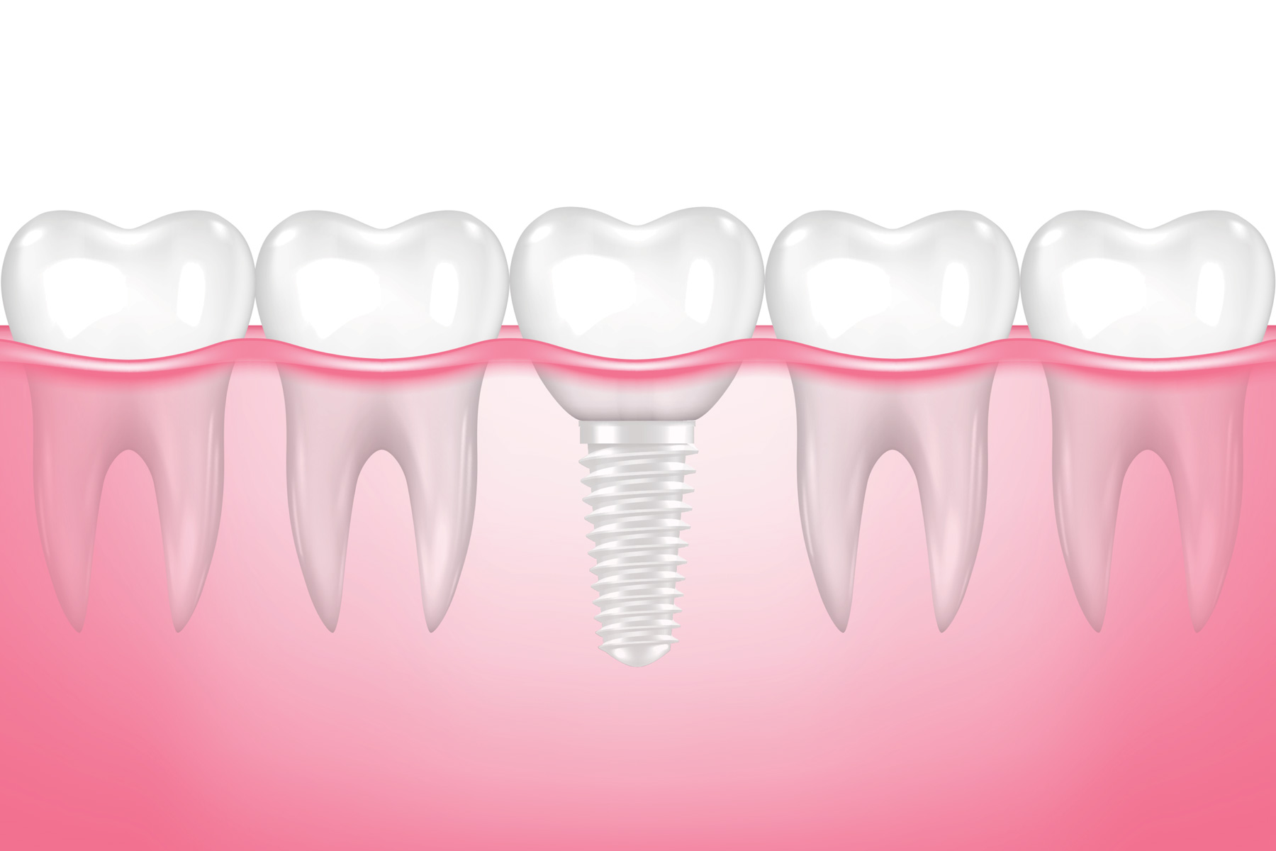 Is Zirconia Implant Really Metalfree & Aria Dental