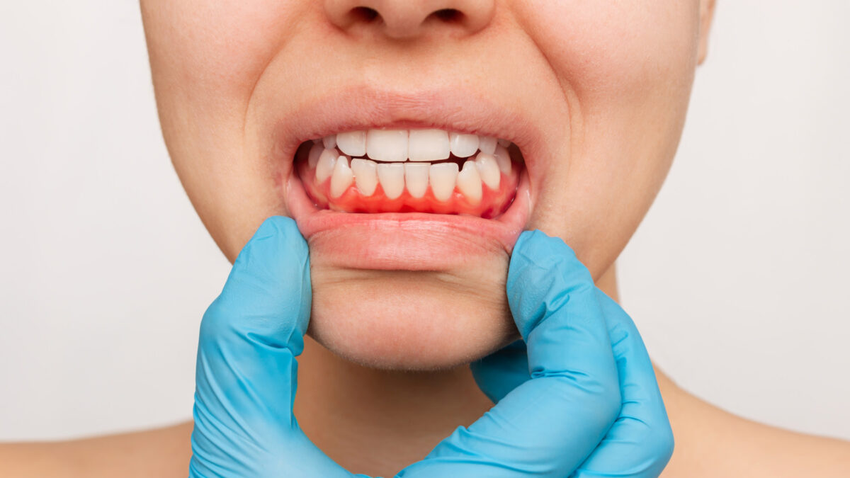 Everything on the LANAP Procedure; Fix Gum Disease with No Cuts & Stitches