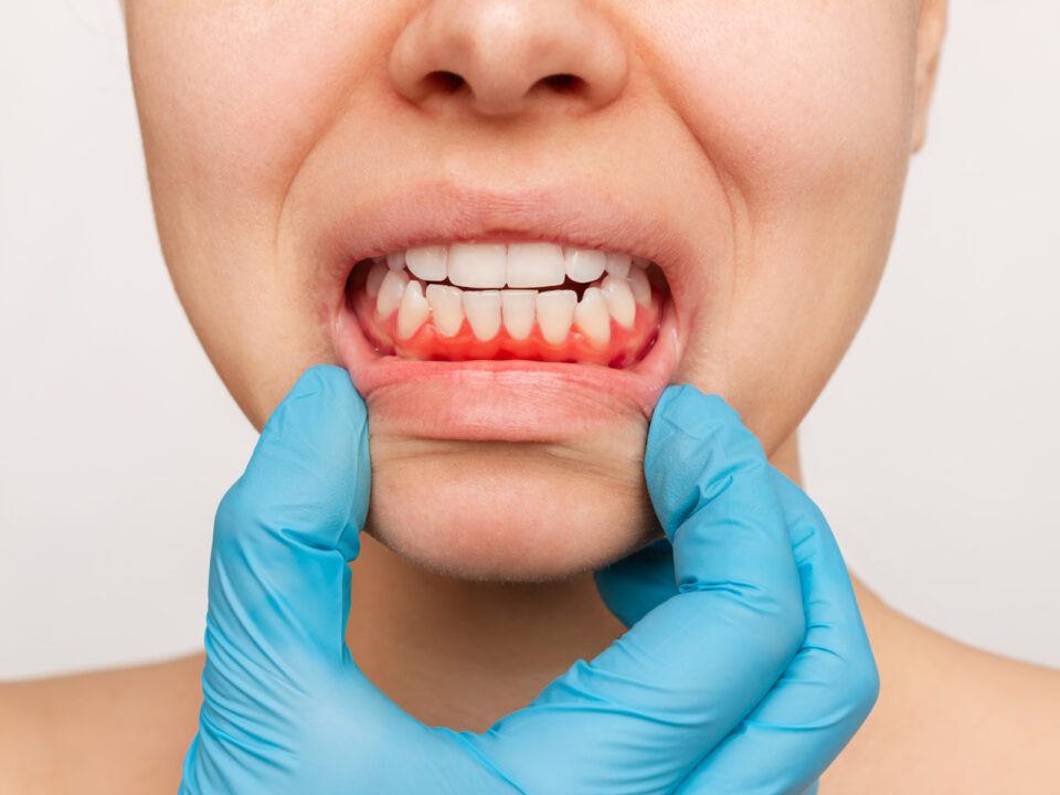 Everything on the LANAP Procedure; Fix Gum Disease with No Cuts & Stitches