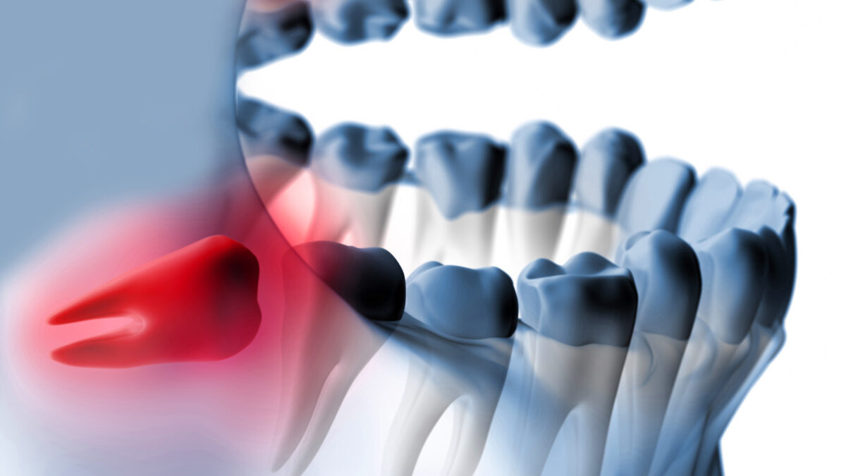 Reasons to Remove Impacted Wisdom Teeth In the Early Stage