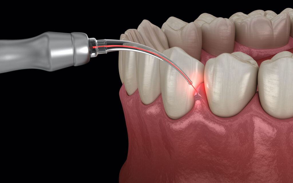 Everything on the LANAP Procedure; Fix Gum Disease with No Cuts & Stitches