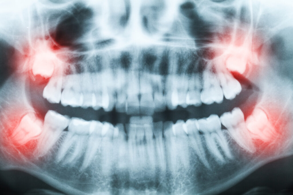 Benefits of Wisdom Teeth Extraction with L-PRF And Ozone Therapy