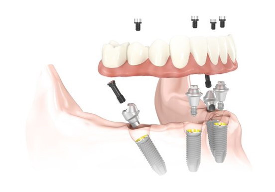 3D illustration of Full-Arch Dental Implants