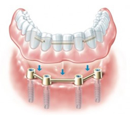 3D illustration of All-on-4 Dental Implants