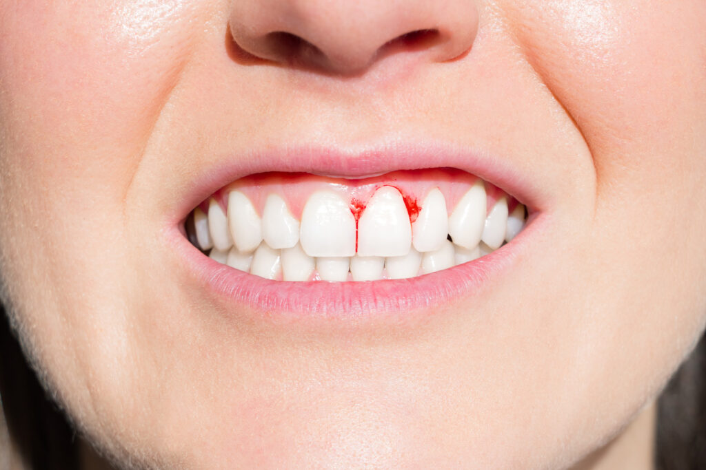 Healthy Teeth And Gums Mean A Healthy Cardiovascular System