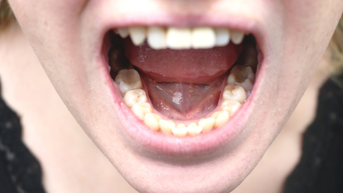 Oral cancer (gum cancer) and gum disease