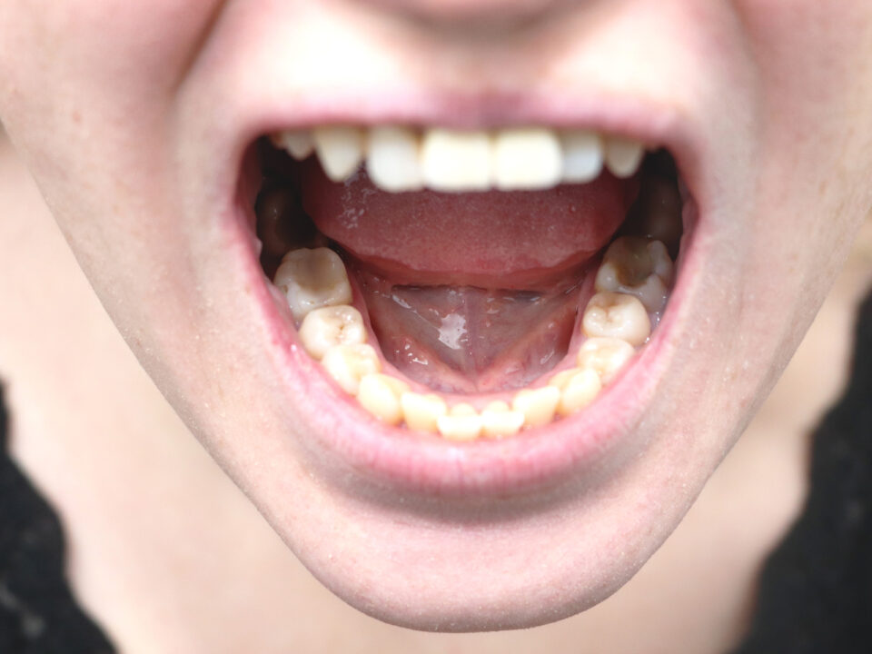Gum Disease May Be Linked to Oral Cancer