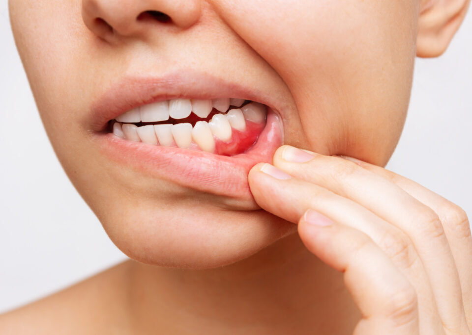 How to Reverse Gum Disease; An Easy Solution