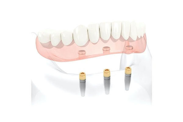 3D illustration of Removable Implant Dentures