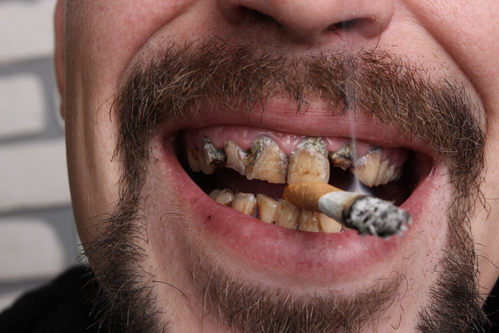 Gum Disease May Be Linked to Oral Cancer