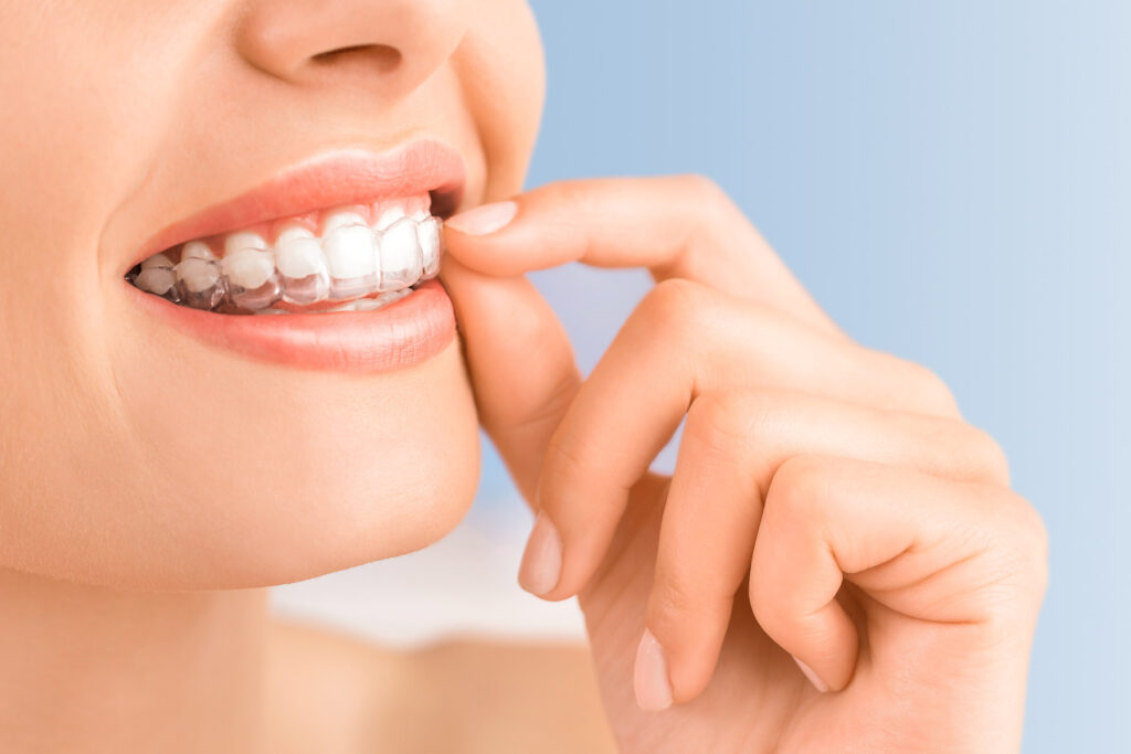 Invisalign® vs. Braces; the Answer Is Clear!