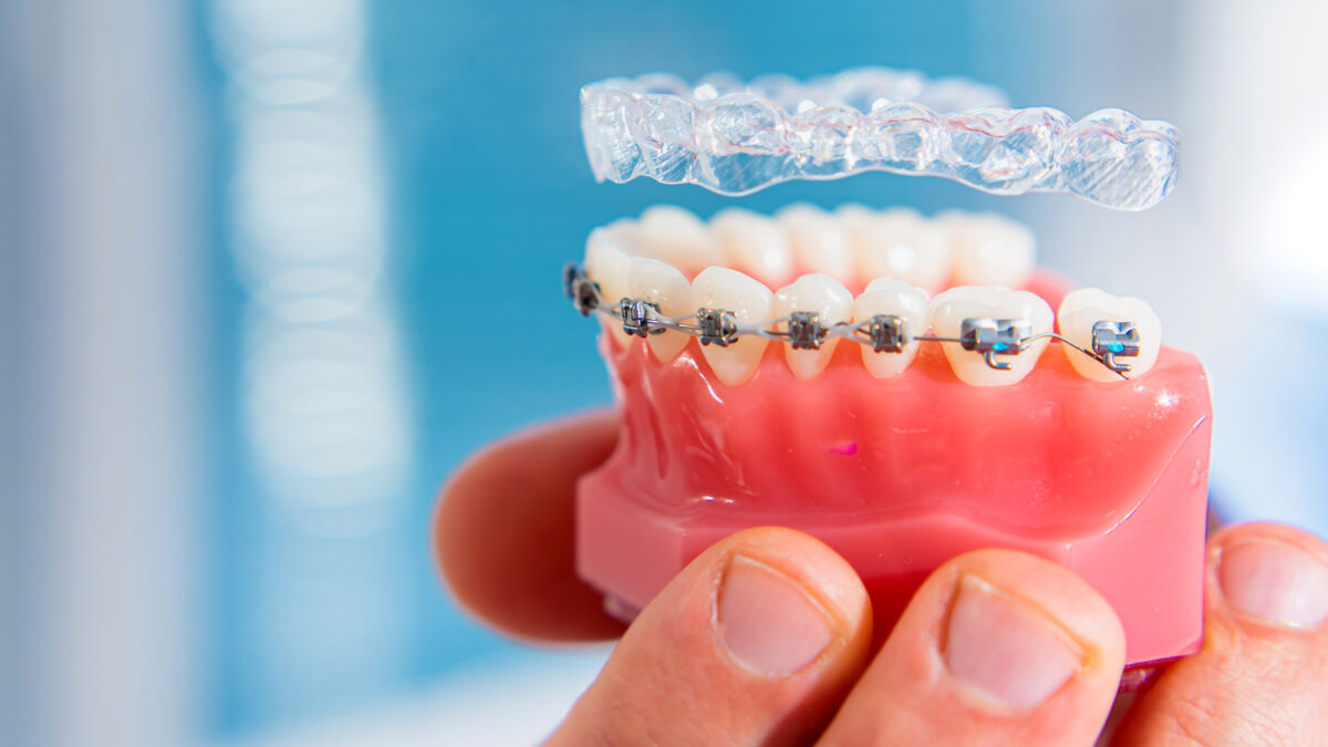 Invisalign® vs. Braces; the Answer Is Clear!
