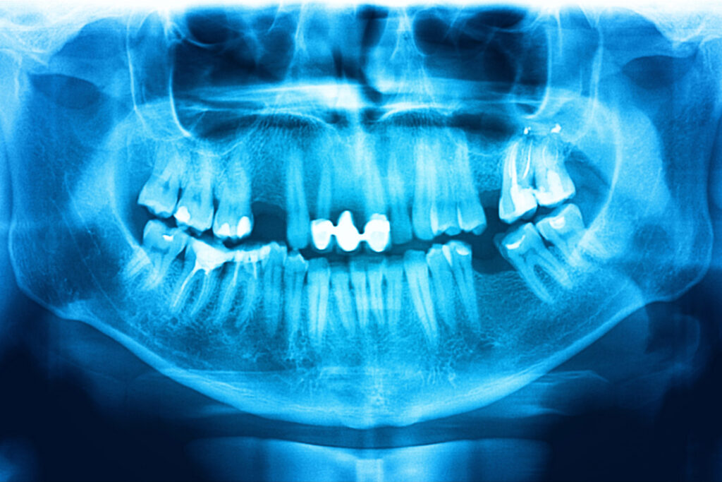 X-Ray image of Missing Tooth