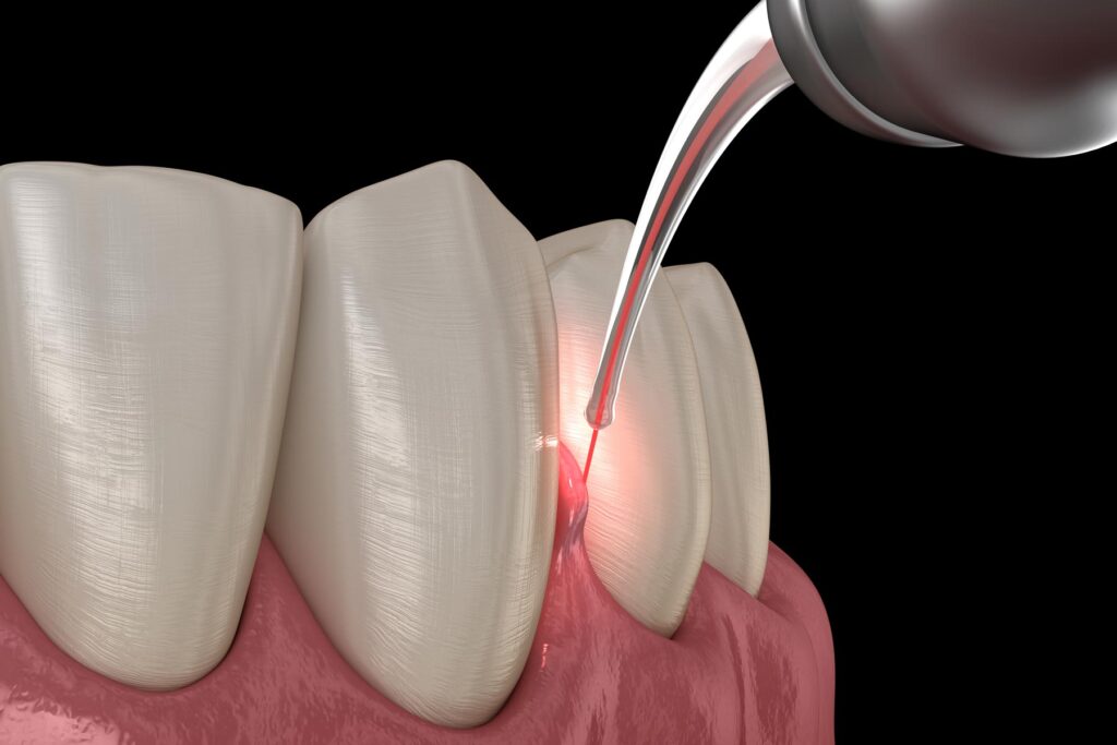 Aria Dental LANAP procedure