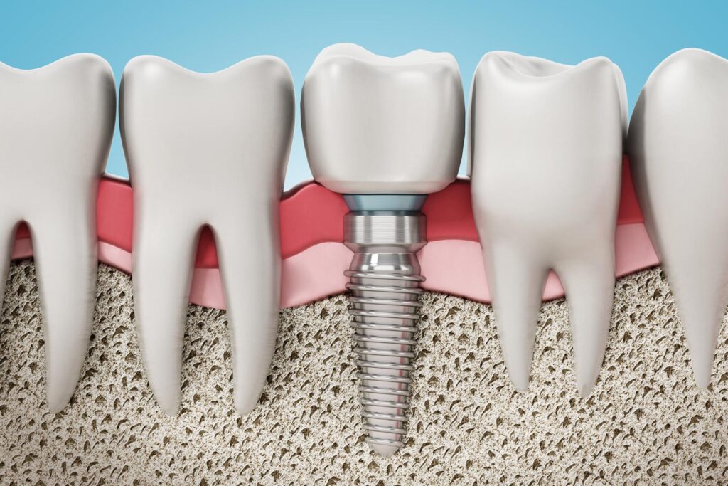 3D demonstration of Dental implants Structure