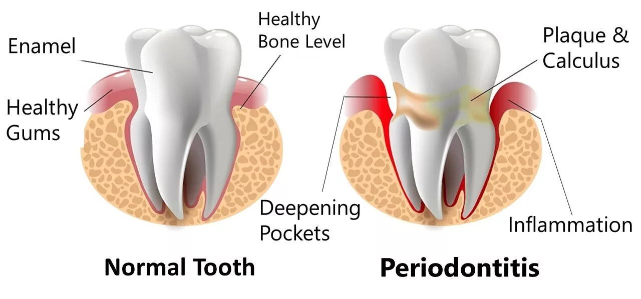 comparison of normal tooth vs. periodontitis