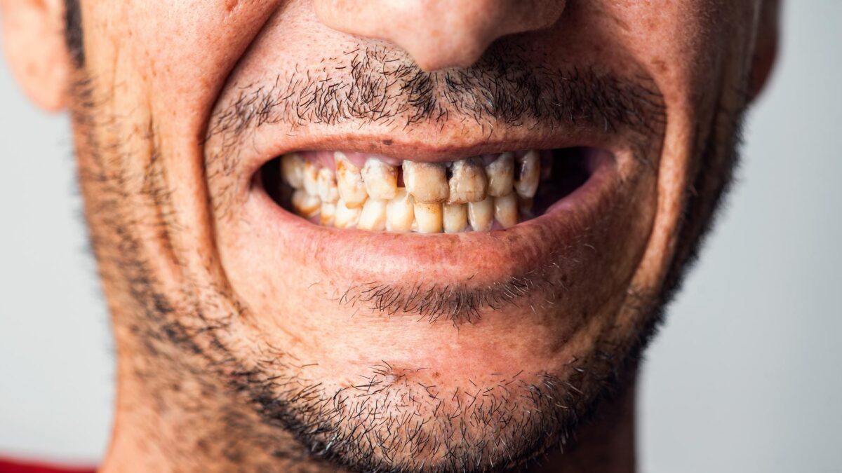 Black lines on teeth of a man