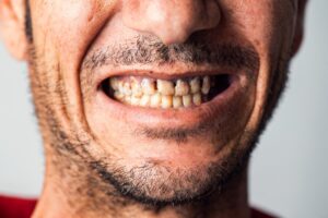 Black lines on teeth of a man