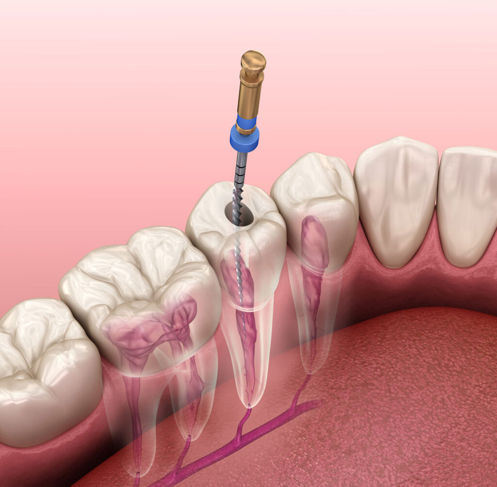 Benefits of Dental Implants over Root Canals