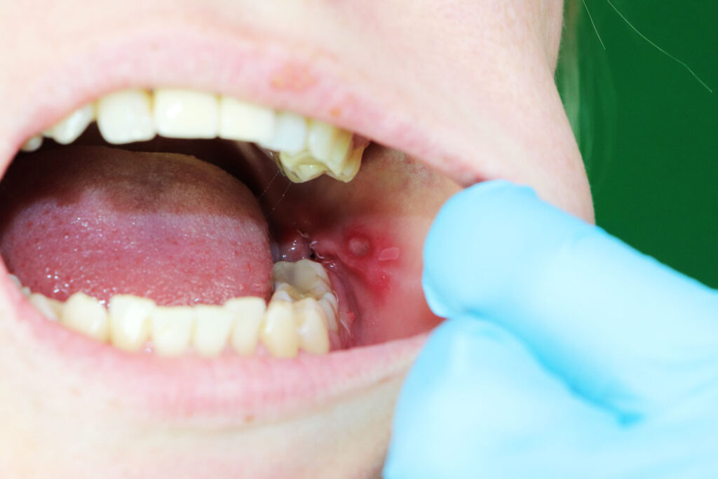 Everything about Canker Sore after Dental Work