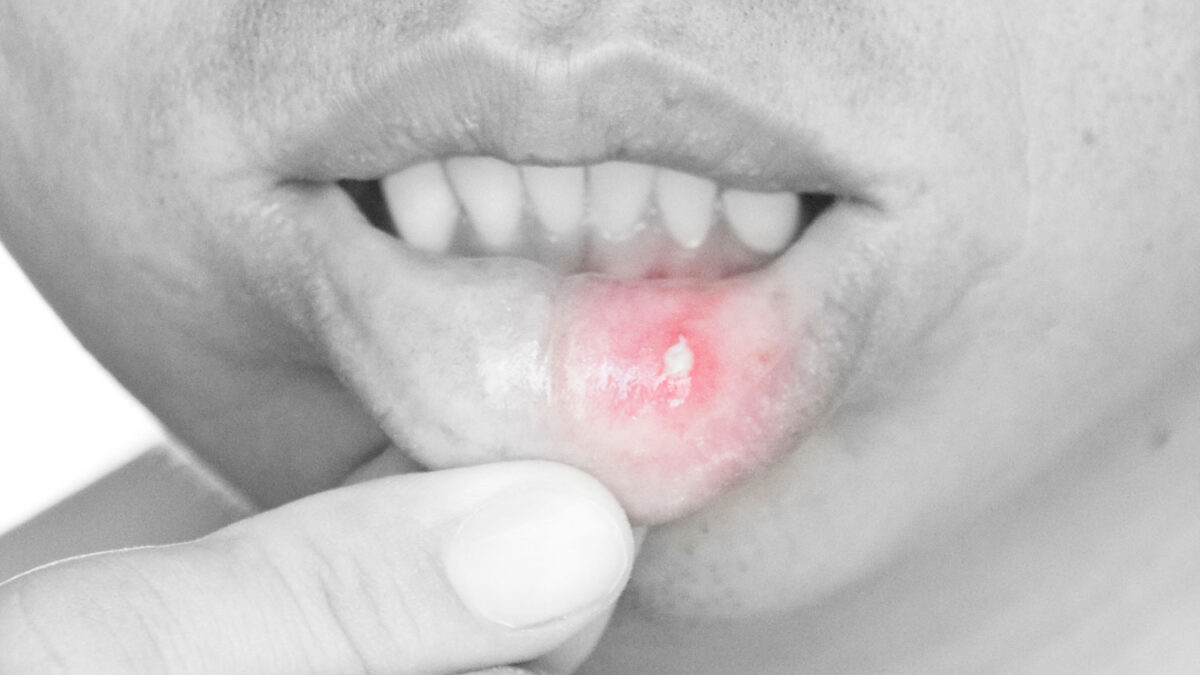 Everything about Canker Sore after Dental Work