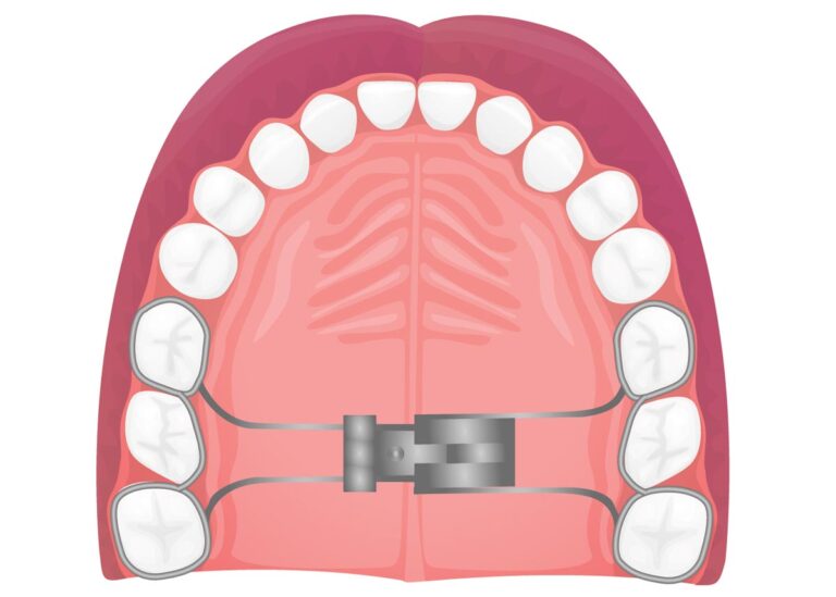 The Ultimate Guide for Palatal Expander Aria Dental