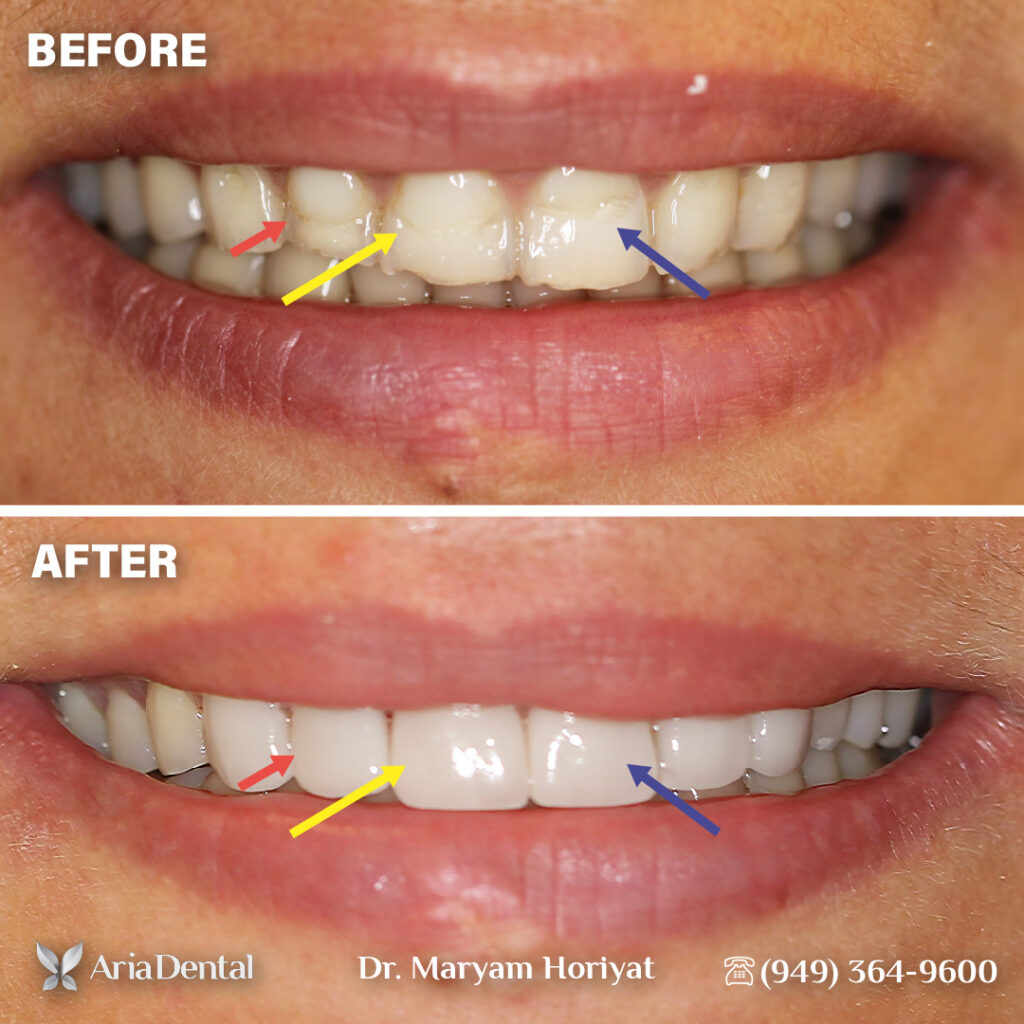 before and after aria dental