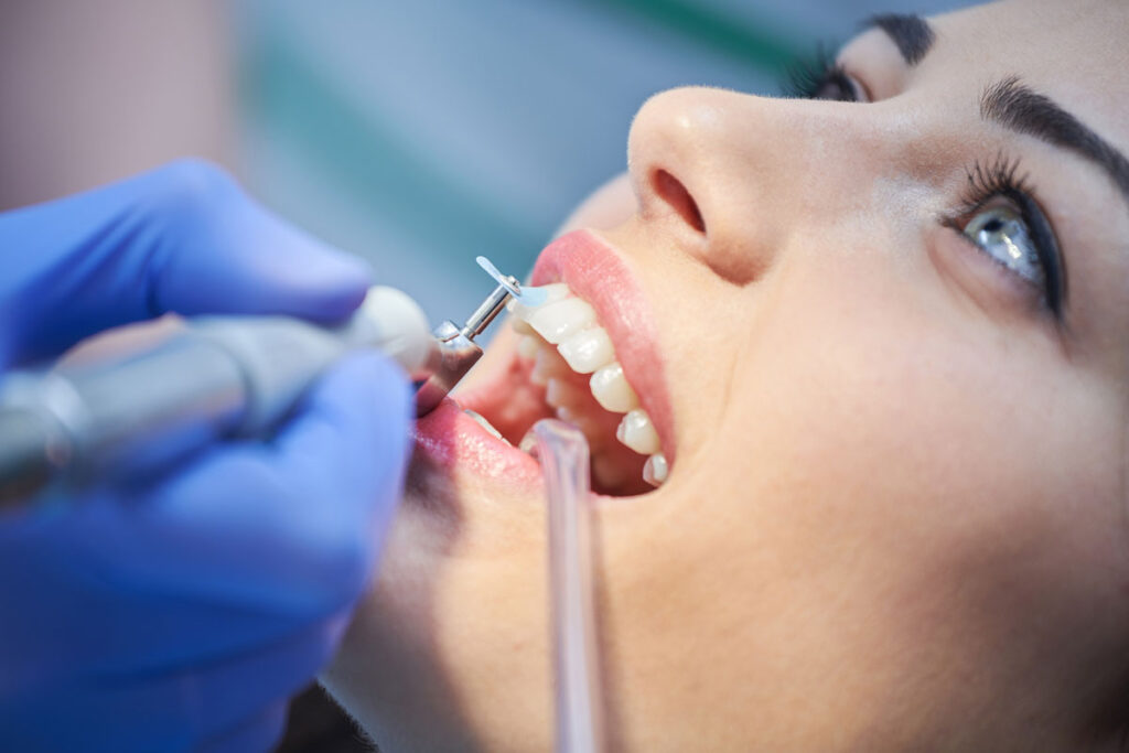 What Is a Dental Deep Cleaning? Should You Consider It?