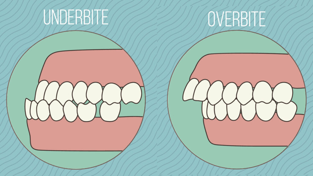 Can Invisalign® fix overbite? How Does It Work?