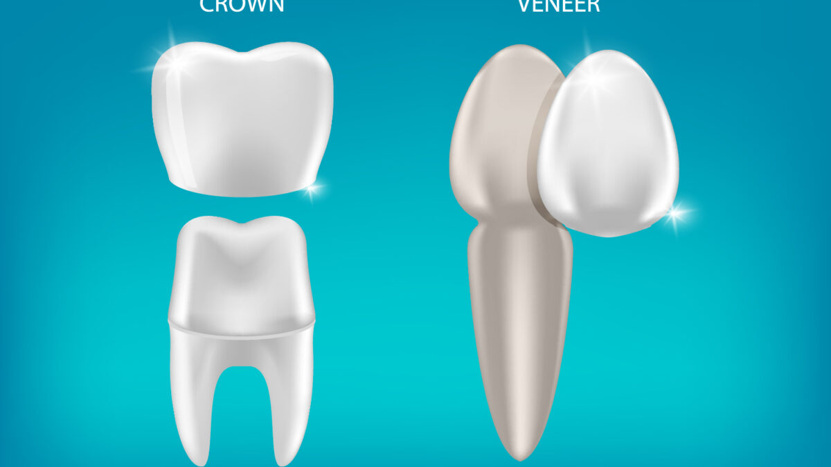 Crown vs. Veneer: Which One Do I Need Now?