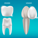 Crown vs. Veneer: Which One Do I Need Now?