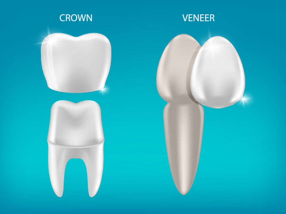 Crown vs. Veneer: Which One Do I Need Now?