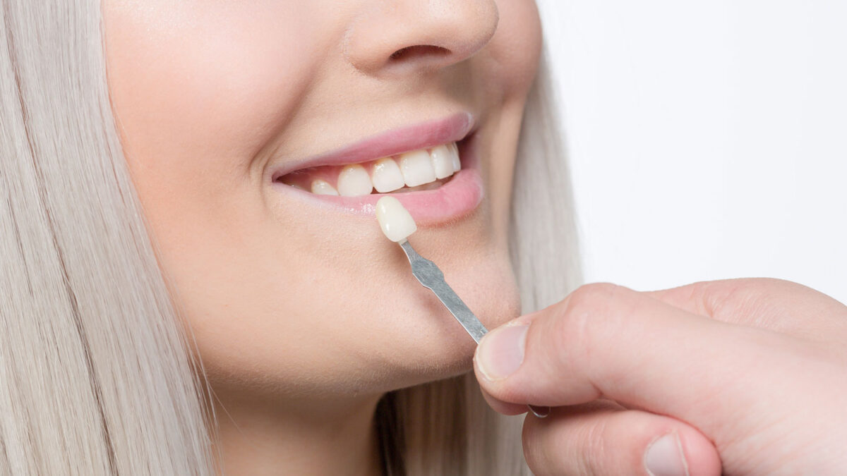 Veneers vs. Lumineers; Every Difference Explained