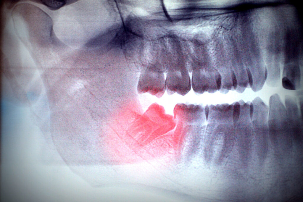 What Are the Dos and Don'ts After Wisdom Tooth Extraction?