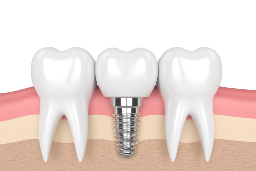 Dental Implants During Pandemic - Getting a loose implant